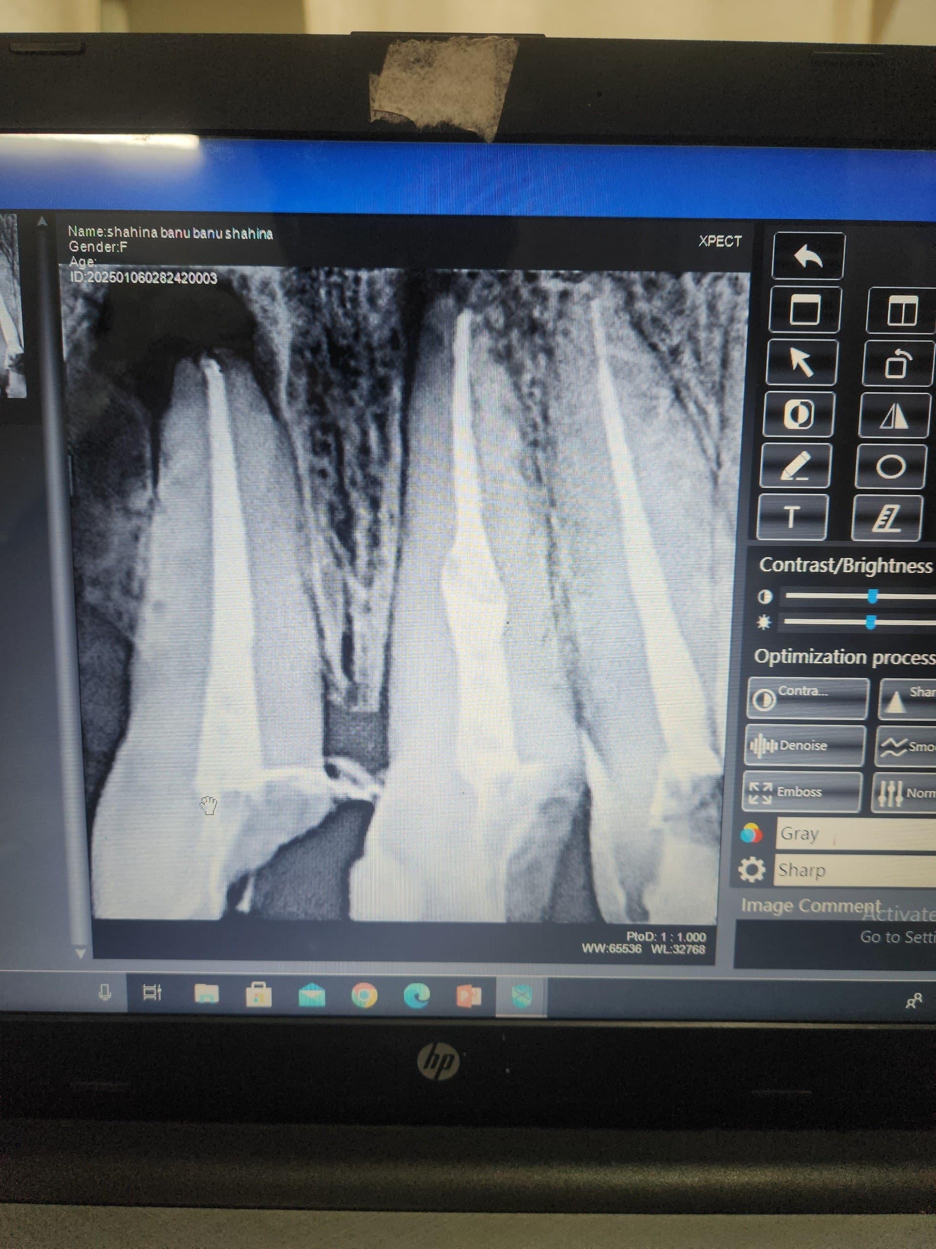 Single-sitting RCT - Endodontics