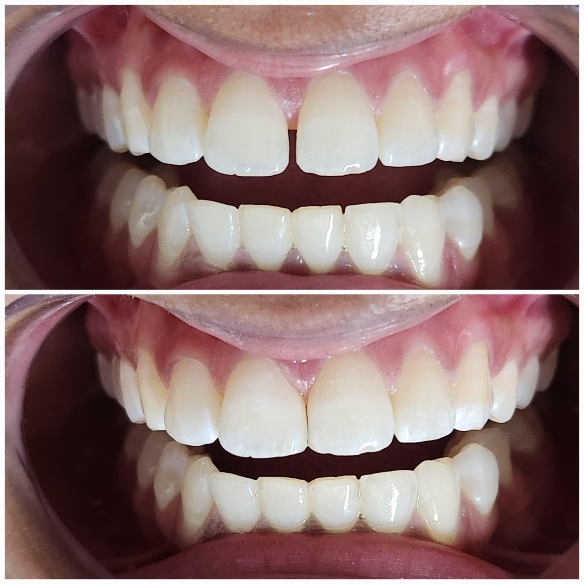 Smile redesign - Veneers · Whitening